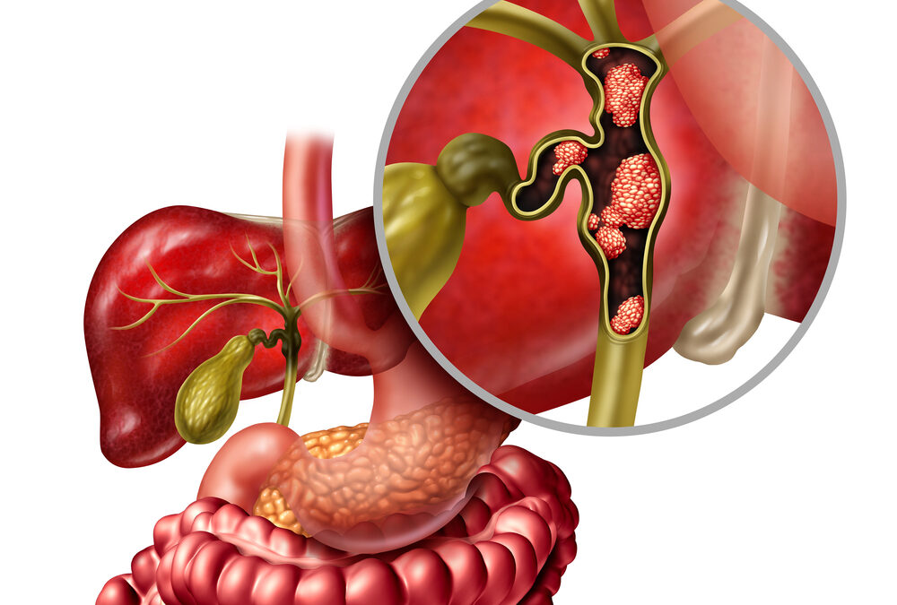 Dr. Kim Saverno | Real-World Impact: How Targeted Therapy is Changing Cholangiocarcinoma Treatment