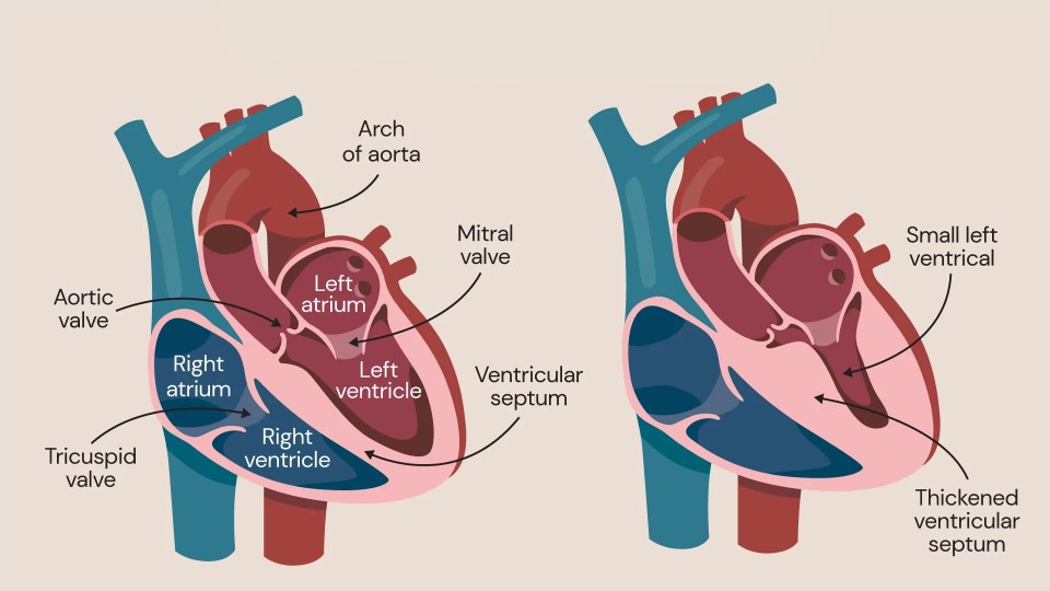 Dr Richard Saumarez | Beyond the Heartbeat: How  Direct Cardiac Investigation Could Save Lives in Hypertrophic Cardiomyopathy and Beyond